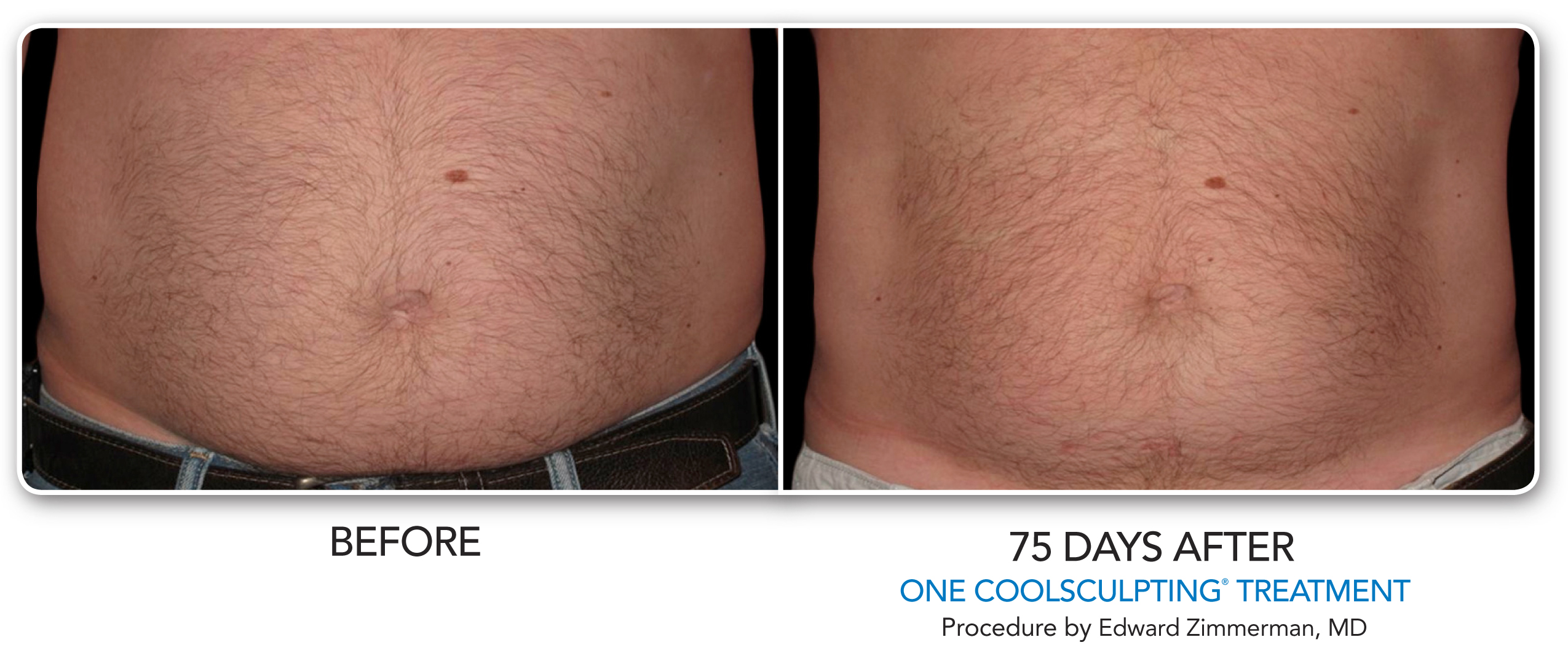 Coolsculpting before and after pictures - Laser & Cosmetic Surgery