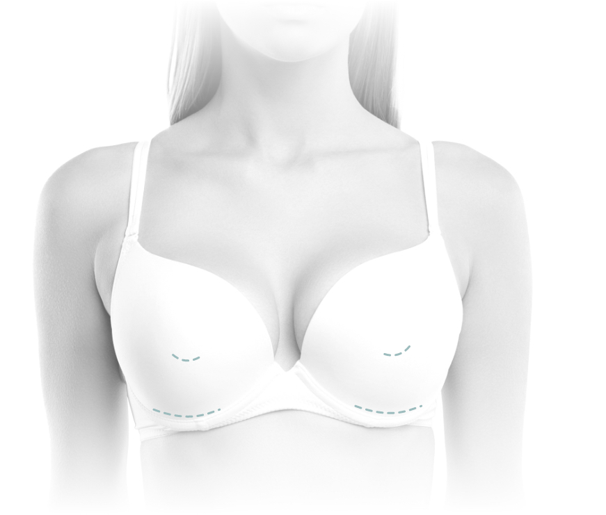 Breast Implant Incision Locations