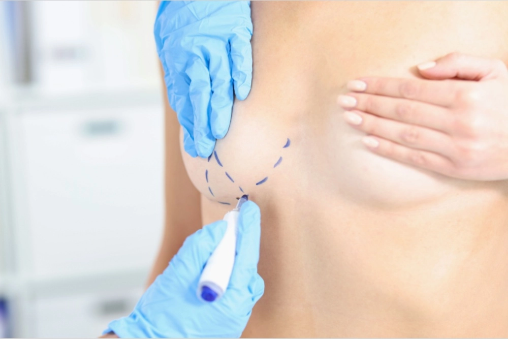 Doctor marking a patient's breast for cosmetic surgery procedure