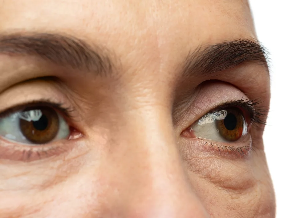 Closeup of a woman's eyes after blepharoplasty